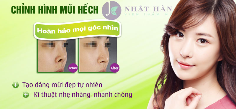 chinh-sua-mui-hech-1-1.jpg