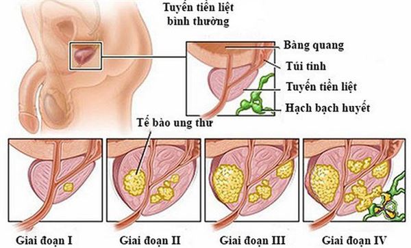 cac-giai-doan-cua-ung-thu-tien-liet-tuyen.jpg