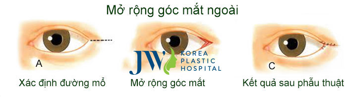 mo-rong-go-mat-ngoai.jpg