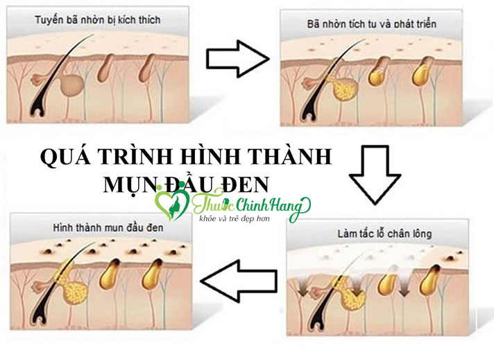 cach-tri-mun-dau-den-hieu-qua.jpg