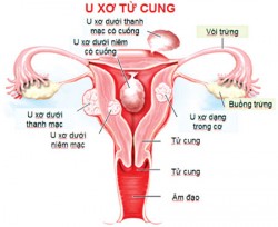 %C4%90i%E1%BB%81u-tr%E1%BB%8B-b%E1%BB%87nh-u-x%C6%A1-t%E1%BB%AD-cung-250x204.jpg