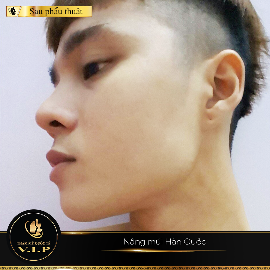 nang-mui-han-quoc-na-vip.png